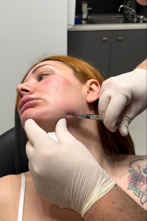 Dermal Filler Treatment