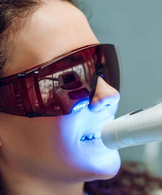 LED Teeth Whitening Frisco